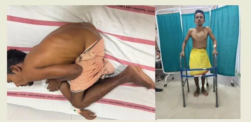 Odisha Man With Severe Spine, Hip Fusion Now Able to Stand And Walk After Complex AIIMS Surgeries