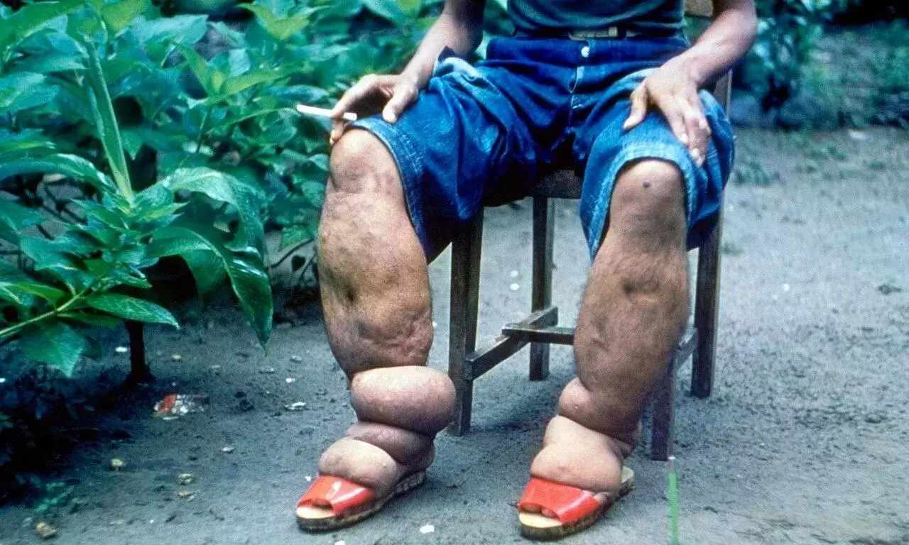 Bhupendra Tripathi | Targeting Lymphatic Filariasis: Mission To Overcome a Lifetime of Disability in India